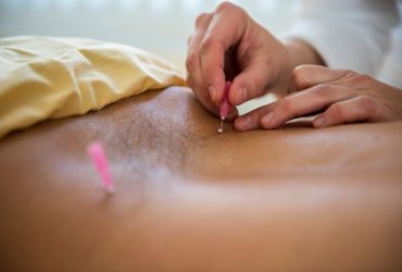 Does Insurance Cover Acupuncture?