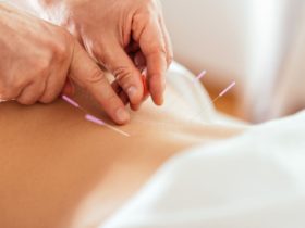 Does Medicaid Cover Acupuncture?
