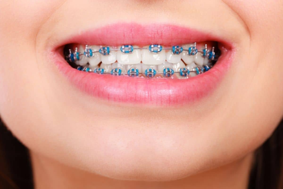 Does Medicare Cover Braces
